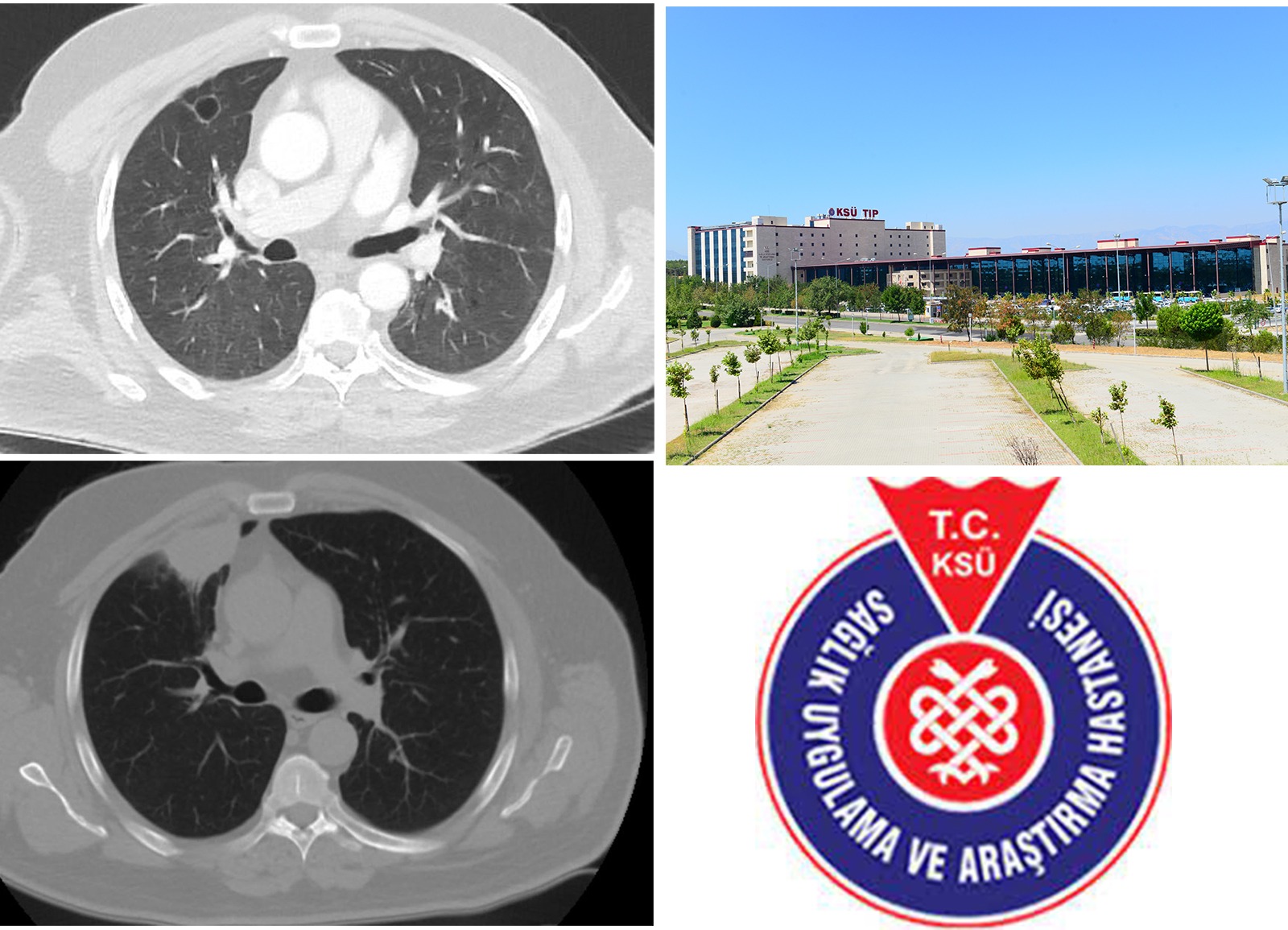 KSÜ Tıp Fakültesinde Yürütülen Çalışmalar Neticesinde Koronavirüsün Akciğer Kanserini Taklit Ettiği Ortaya Çıktı 